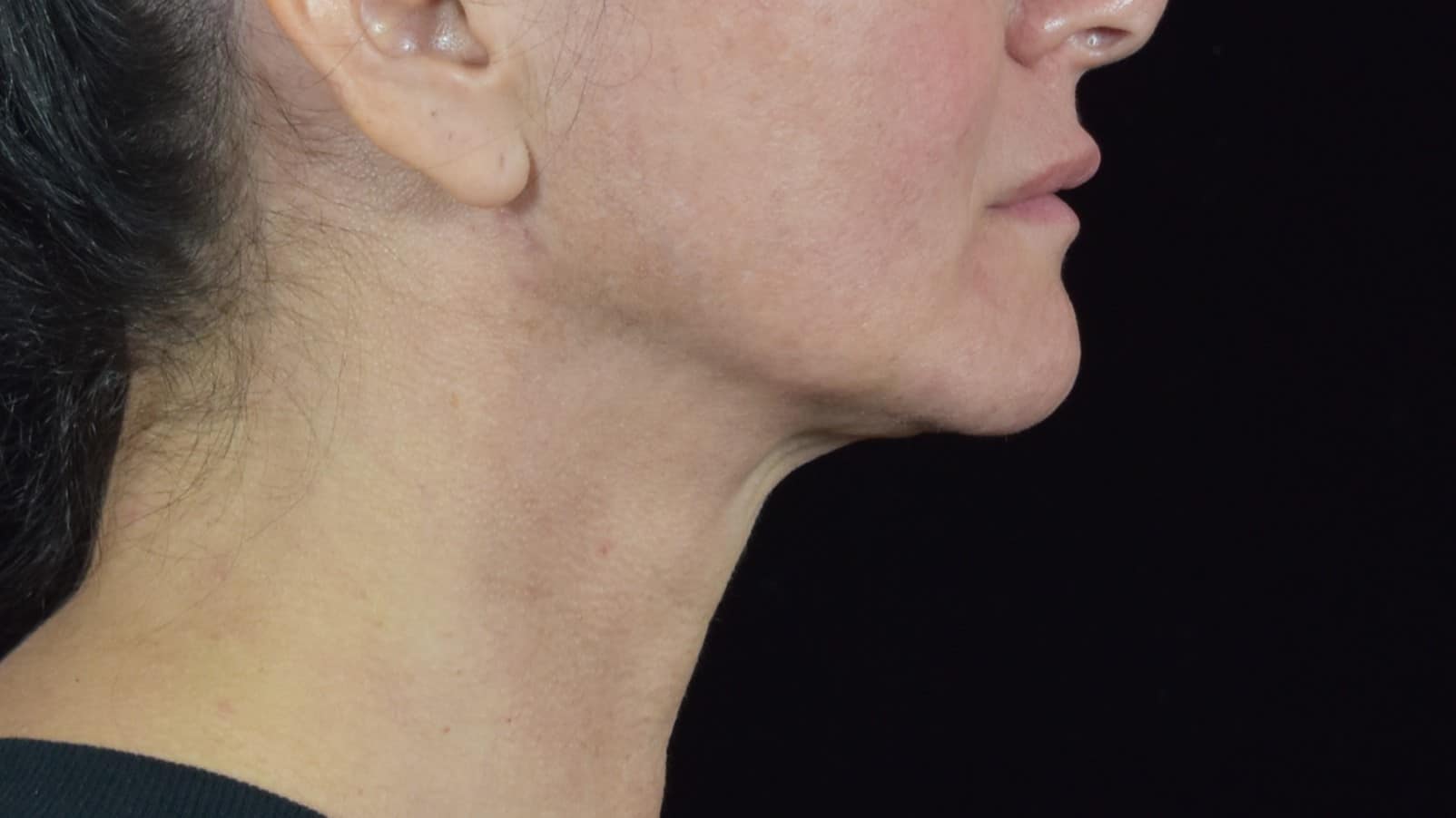 FaceTite/Accutite/Neck & Jawline Liposuction Patient Photo - Case 8600 - after view