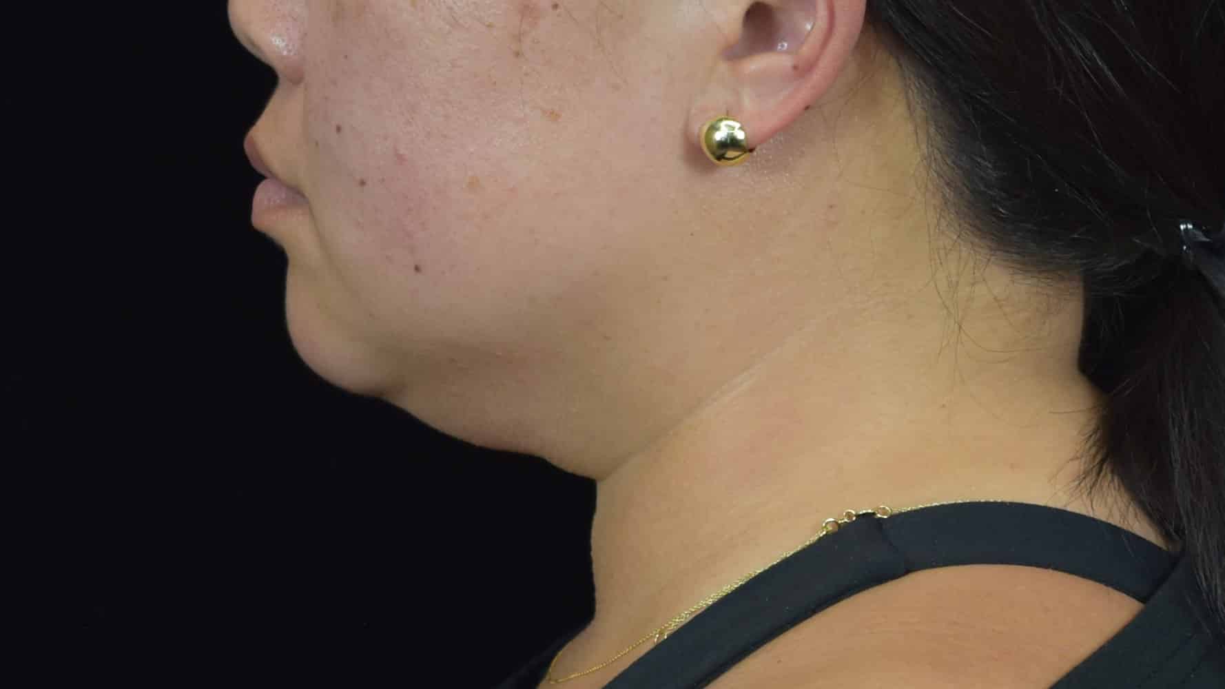 FaceTite/Accutite/Neck & Jawline Liposuction Patient Photo - Case 8604 - before view-1