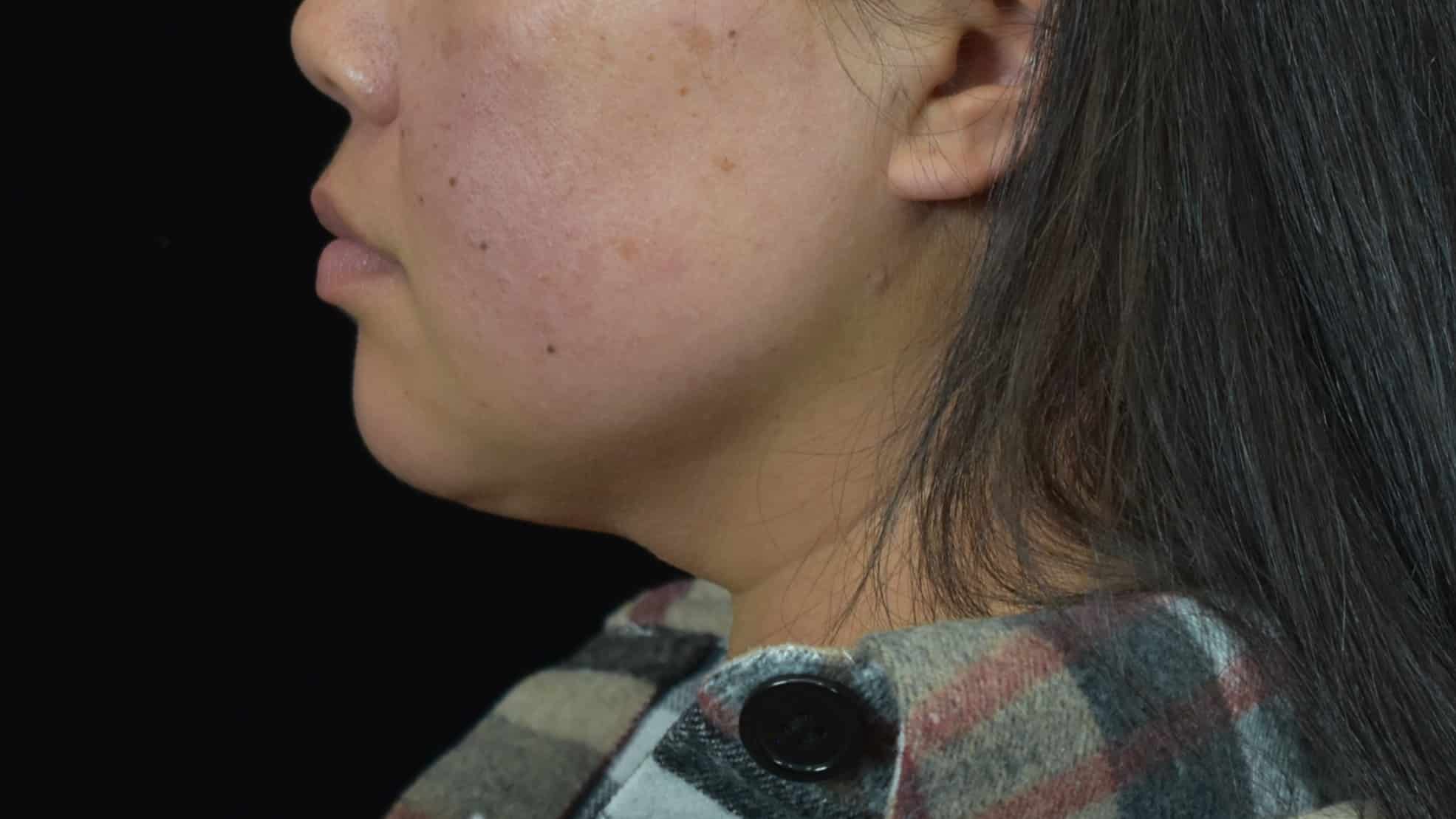 FaceTite/Accutite/Neck & Jawline Liposuction Patient Photo - Case 8604 - after view-1