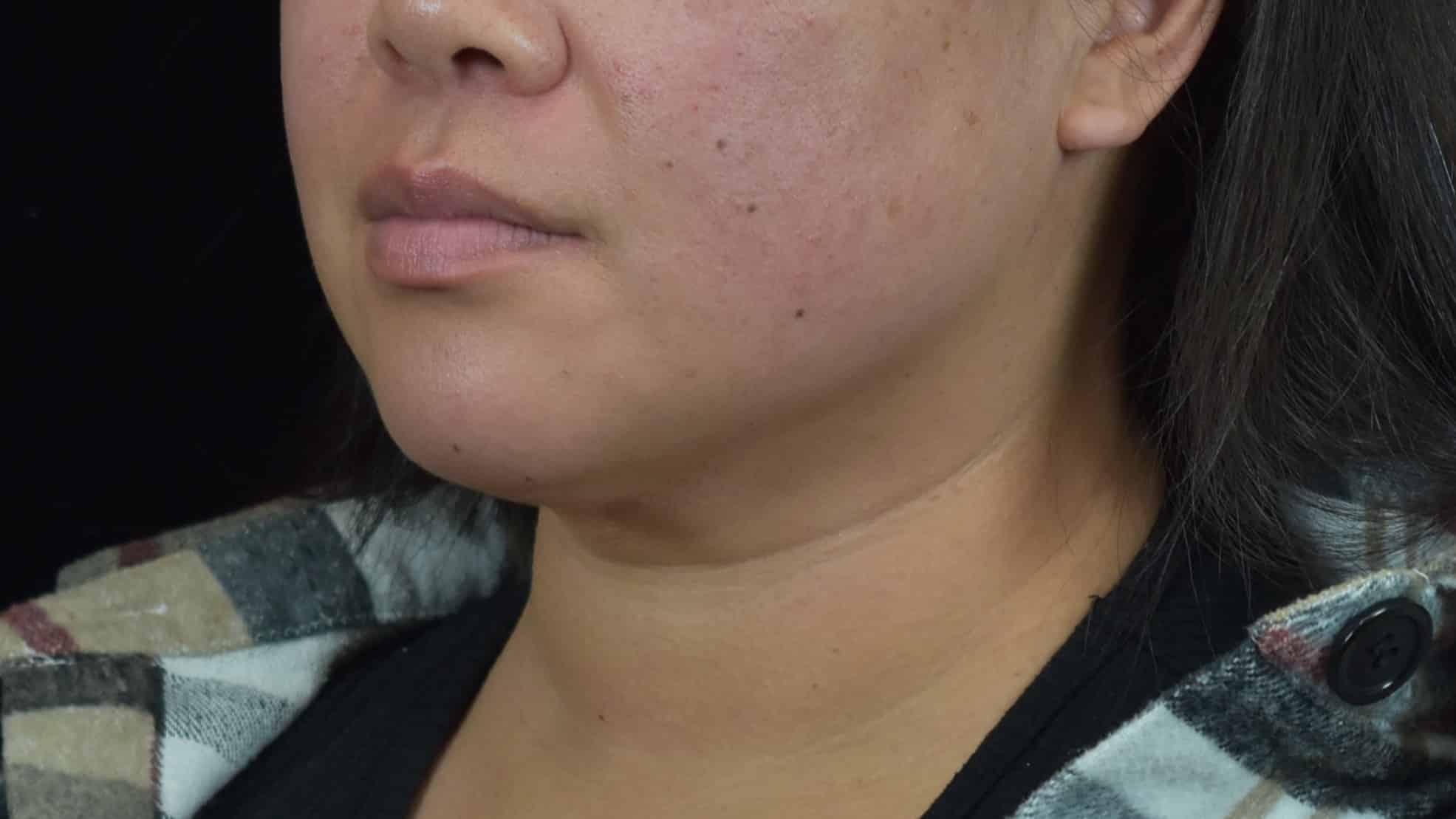 FaceTite/Accutite/Neck & Jawline Liposuction Patient Photo - Case 8604 - after view