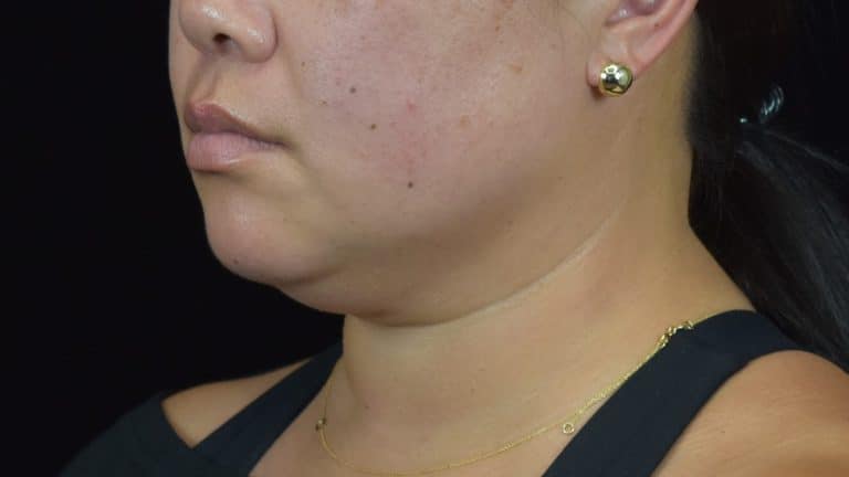 FaceTite/Accutite/Neck & Jawline Liposuction - Case 8604 - Before