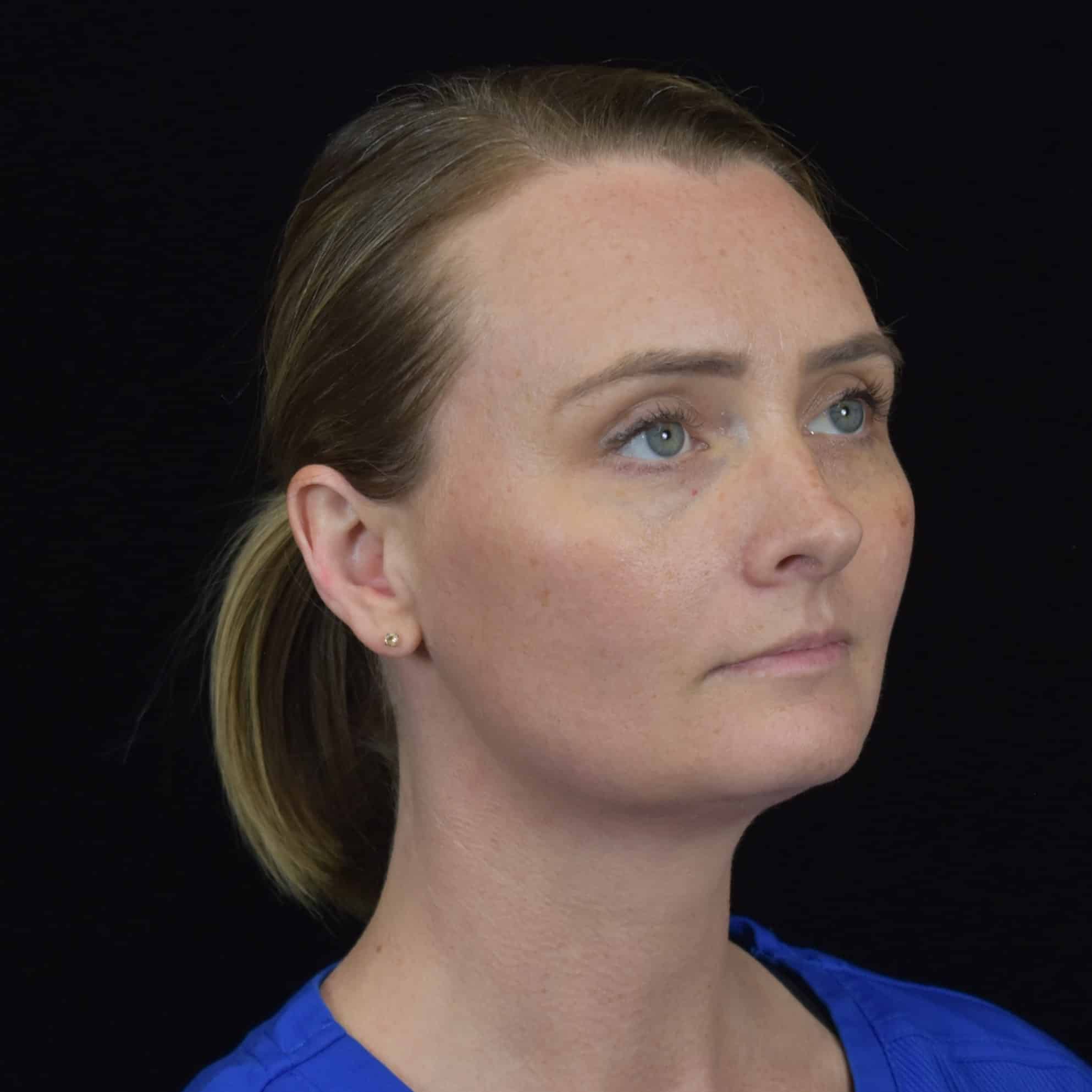 FaceTite/Accutite/Neck & Jawline Liposuction Patient Photo - Case 8610 - after view-1