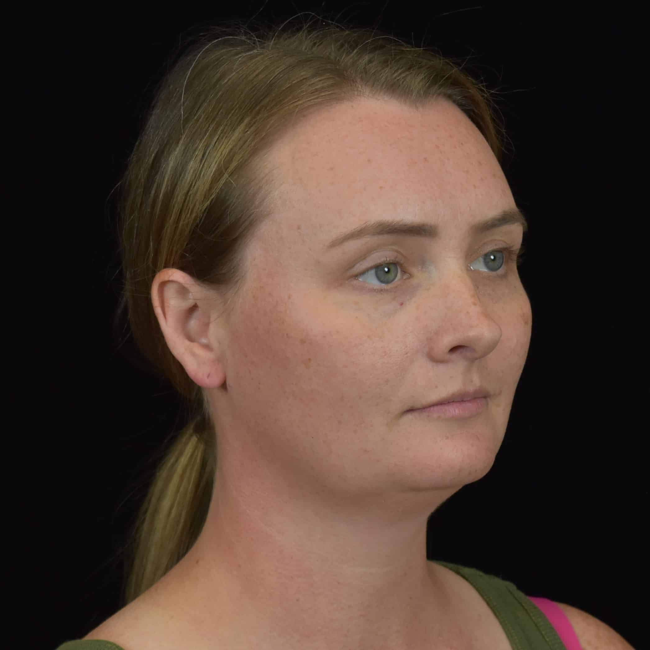 FaceTite/Accutite/Neck & Jawline Liposuction Patient Photo - Case 8610 - before view-1