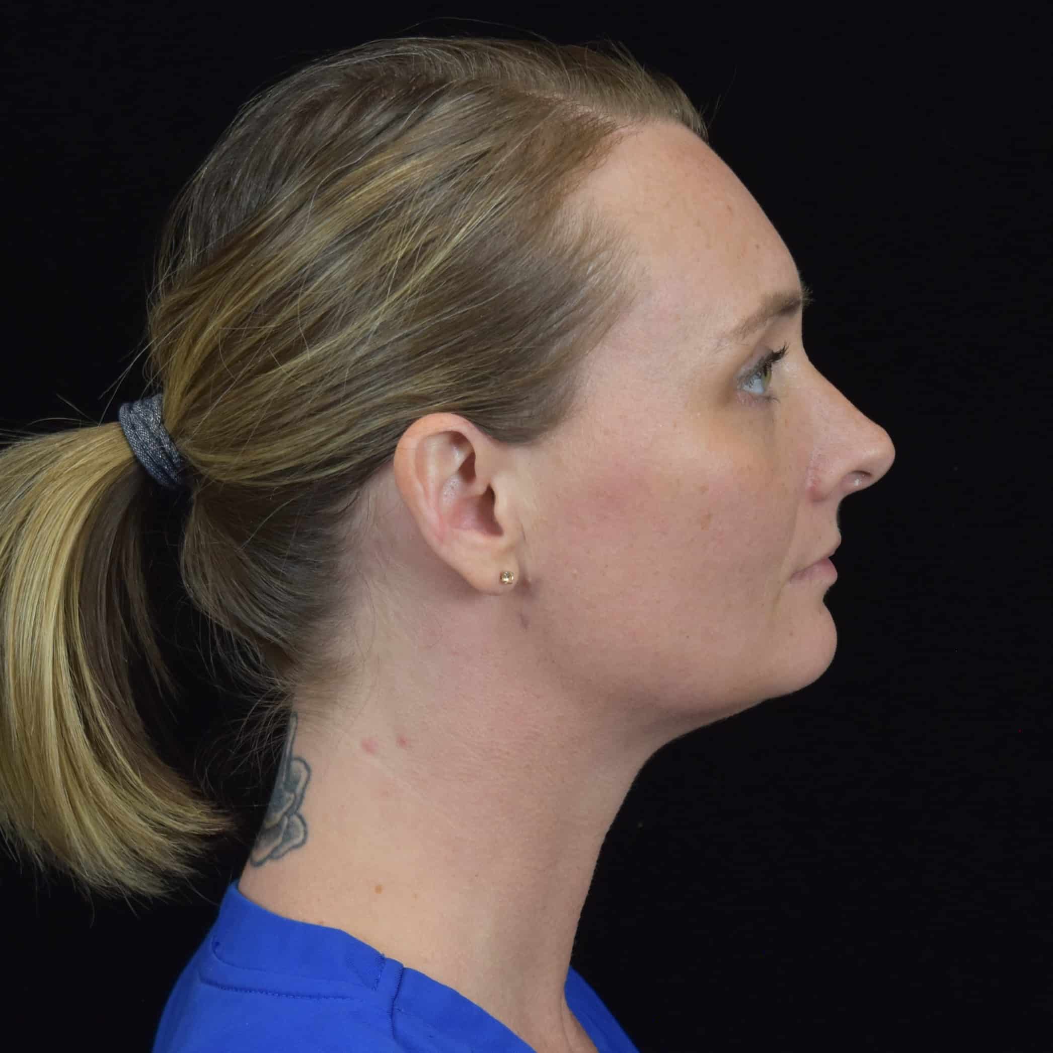 FaceTite/Accutite/Neck & Jawline Liposuction Patient Photo - Case 8610 - after view