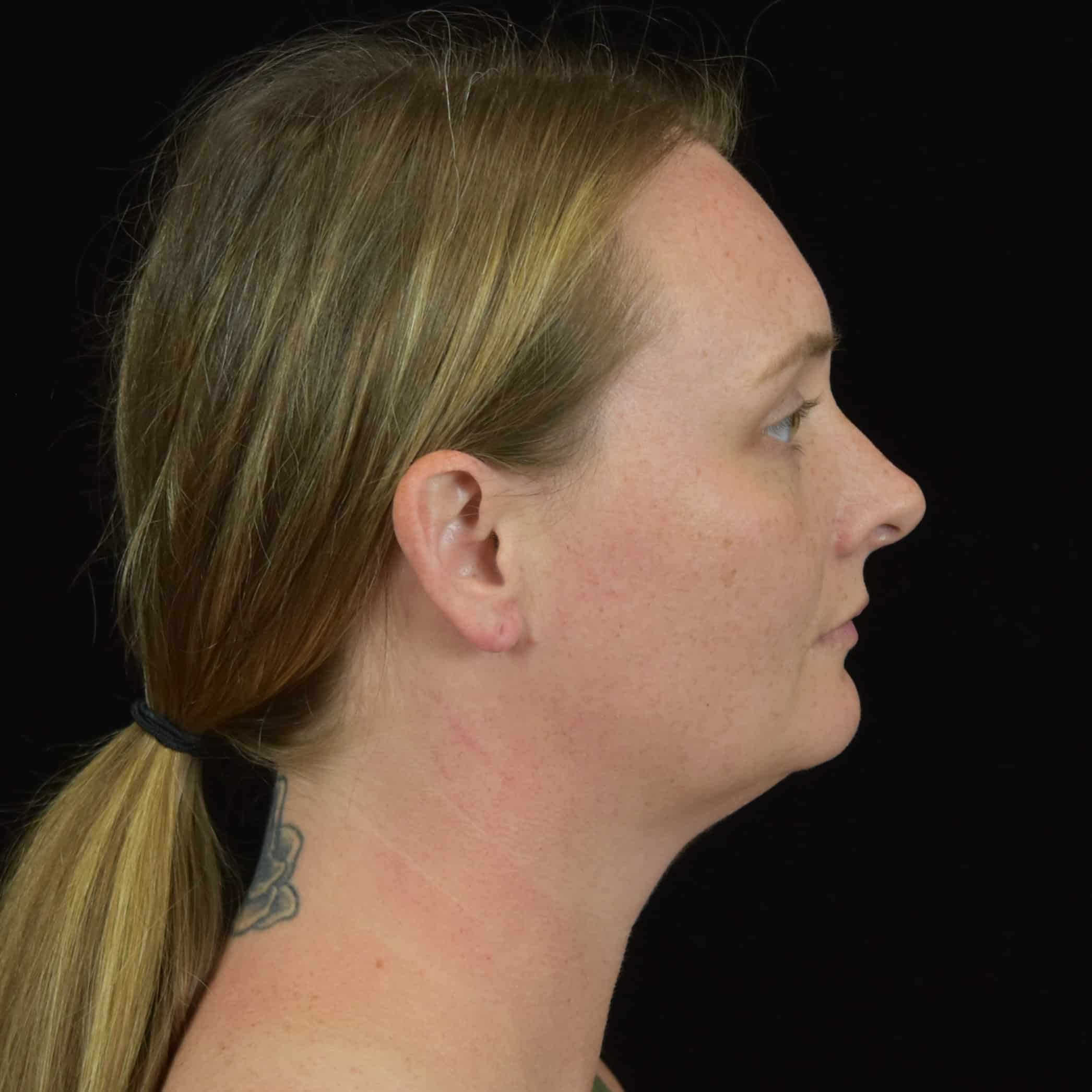 FaceTite/Accutite/Neck & Jawline Liposuction Patient Photo - Case 8610 - before view-