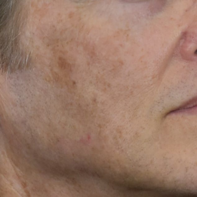 Lumecca IPL (Intense Pulsed Light) Patient Photo - Case 8616 - before view-1