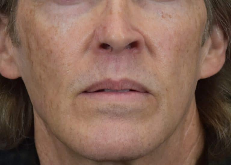 Lumecca IPL (Intense Pulsed Light) - Case 8616 - Before