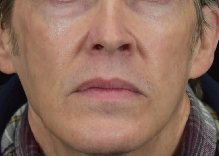 Lumecca IPL (Intense Pulsed Light) - Case 8616 - After