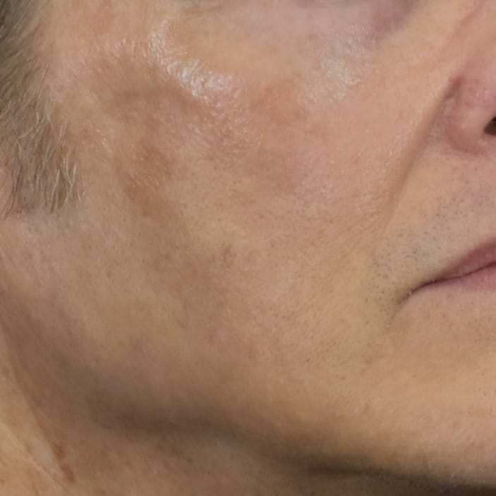 Lumecca IPL (Intense Pulsed Light) Patient Photo - Case 8616 - after view-1