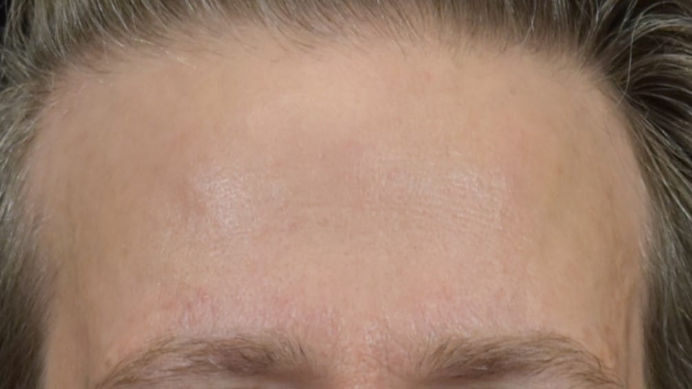 Lumecca IPL (Intense Pulsed Light) Patient Photo - Case 8616 - after view-2