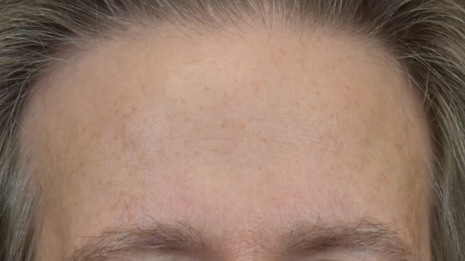 Lumecca IPL (Intense Pulsed Light) Patient Photo - Case 8616 - before view-2