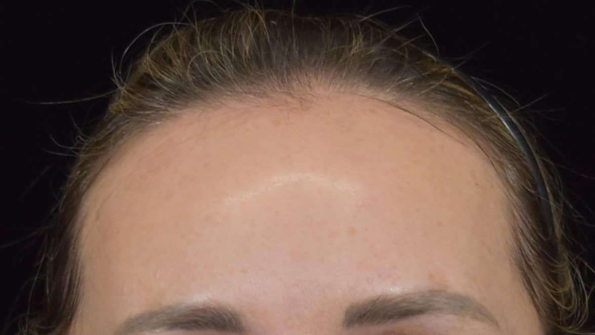 Lumecca IPL (Intense Pulsed Light) Patient Photo - Case 8624 - after view-3