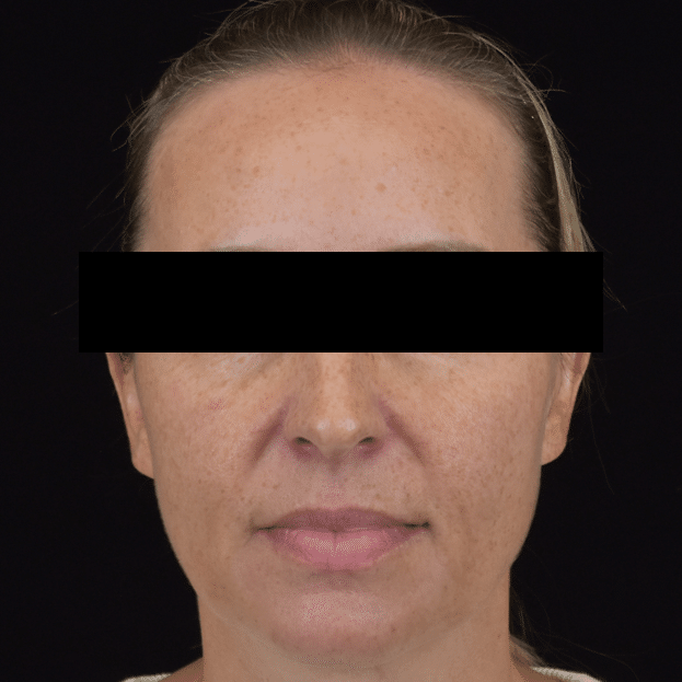 Lumecca IPL (Intense Pulsed Light) - Case 8624 - Before