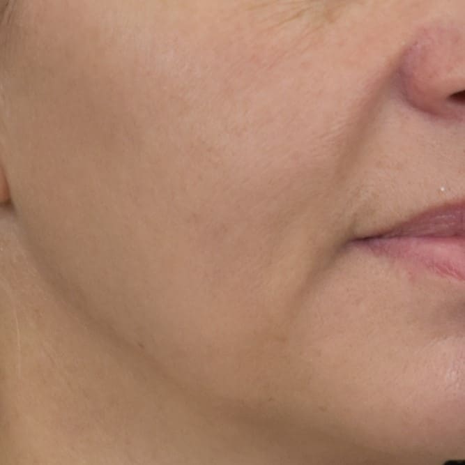 Lumecca IPL (Intense Pulsed Light) Patient Photo - Case 8624 - after view-2