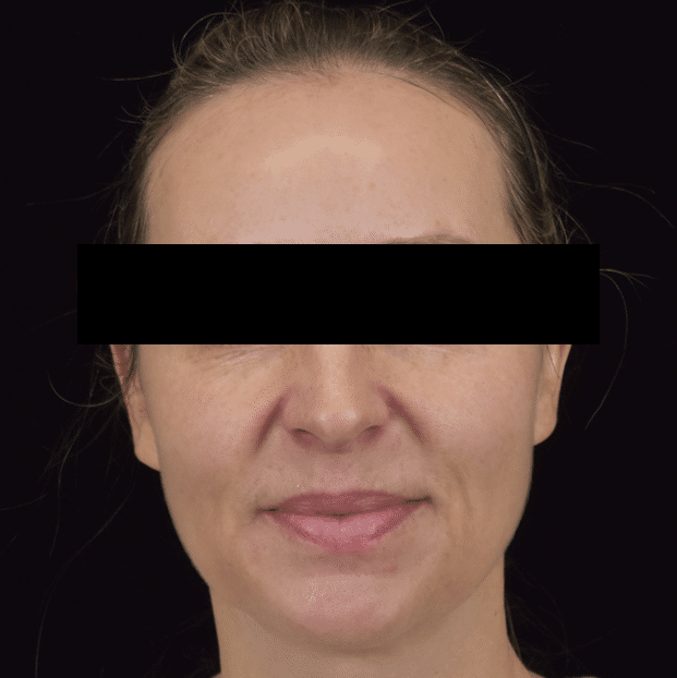 Lumecca IPL (Intense Pulsed Light) - Case 8624 - After