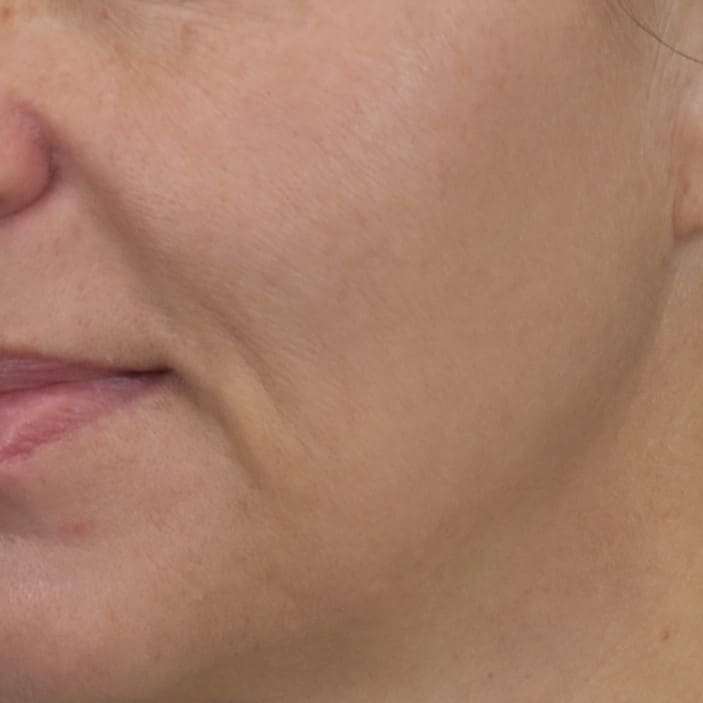 Lumecca IPL (Intense Pulsed Light) Patient Photo - Case 8624 - after view-1