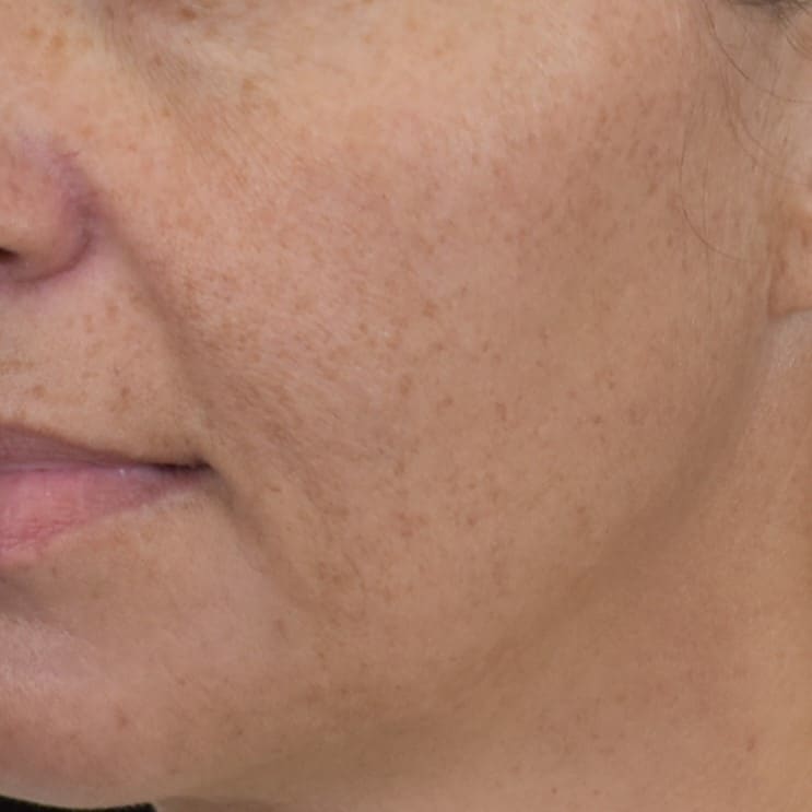 Lumecca IPL (Intense Pulsed Light) Patient Photo - Case 8624 - before view-1