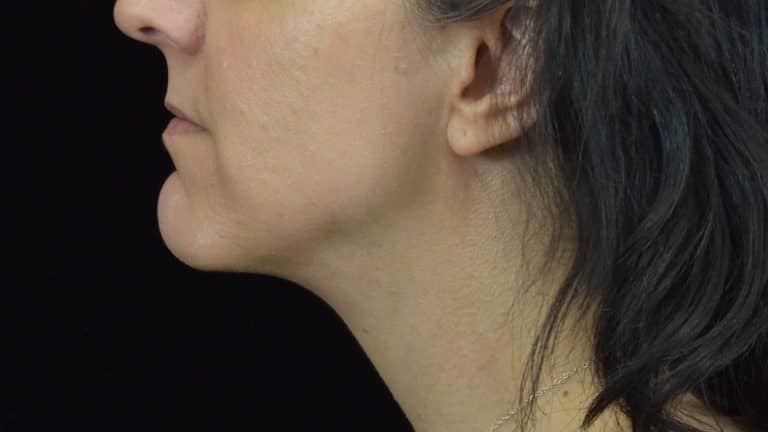 FaceTite/Accutite/Neck & Jawline Liposuction - Case 8634 - After