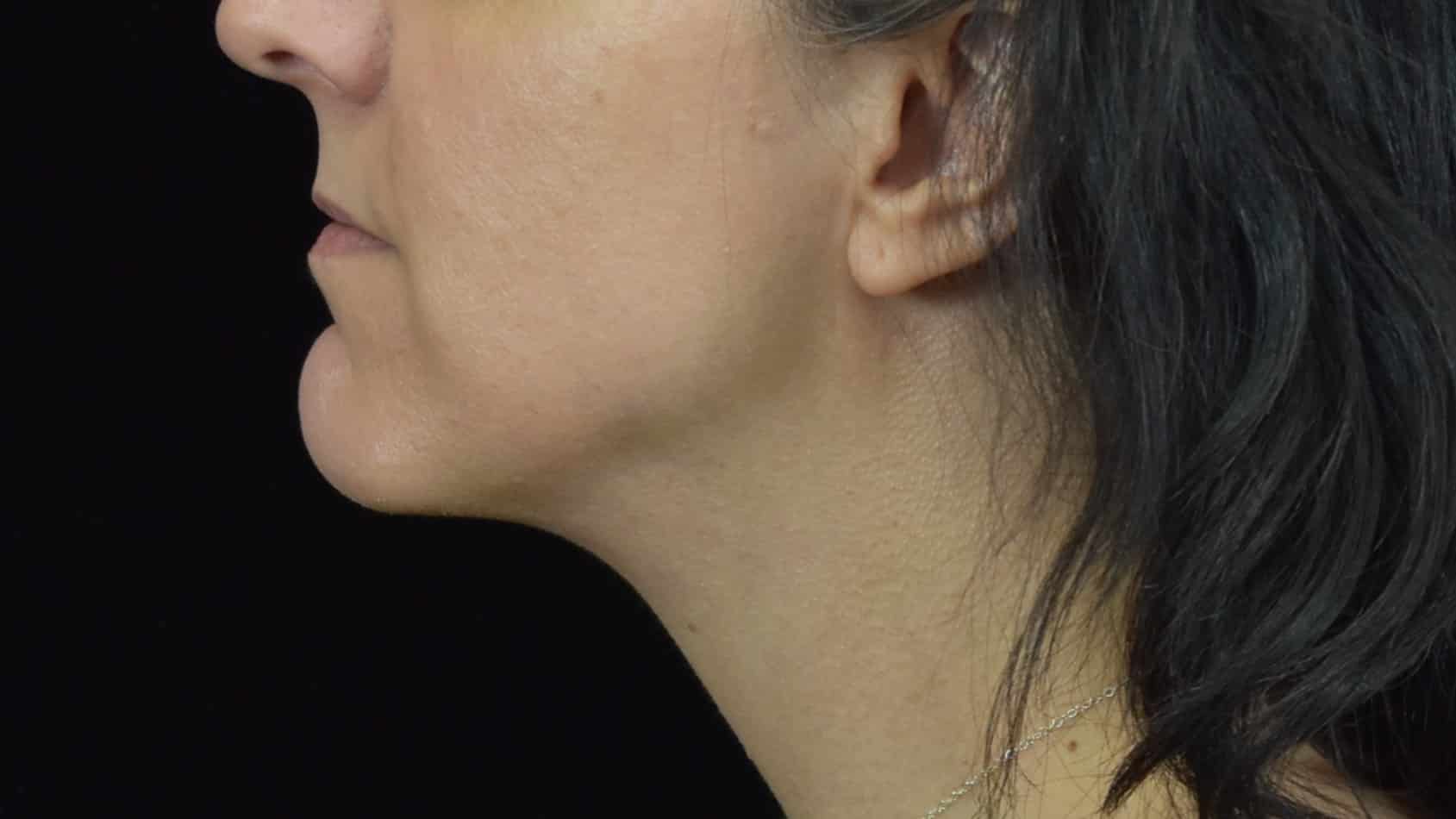 FaceTite/Accutite/Neck & Jawline Liposuction Patient Photo - Case 8634 - after view