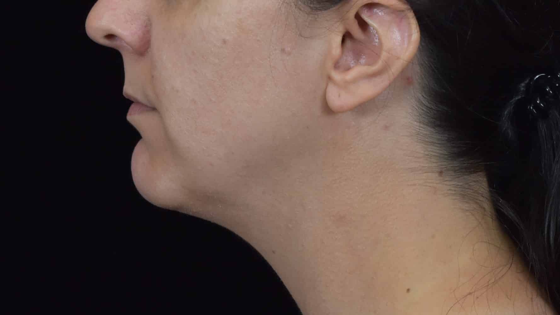 FaceTite/Accutite/Neck & Jawline Liposuction Patient Photo - Case 8634 - before view-