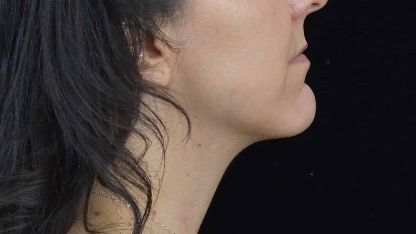 FaceTite/Accutite/Neck & Jawline Liposuction Patient Photo - Case 8634 - after view-1