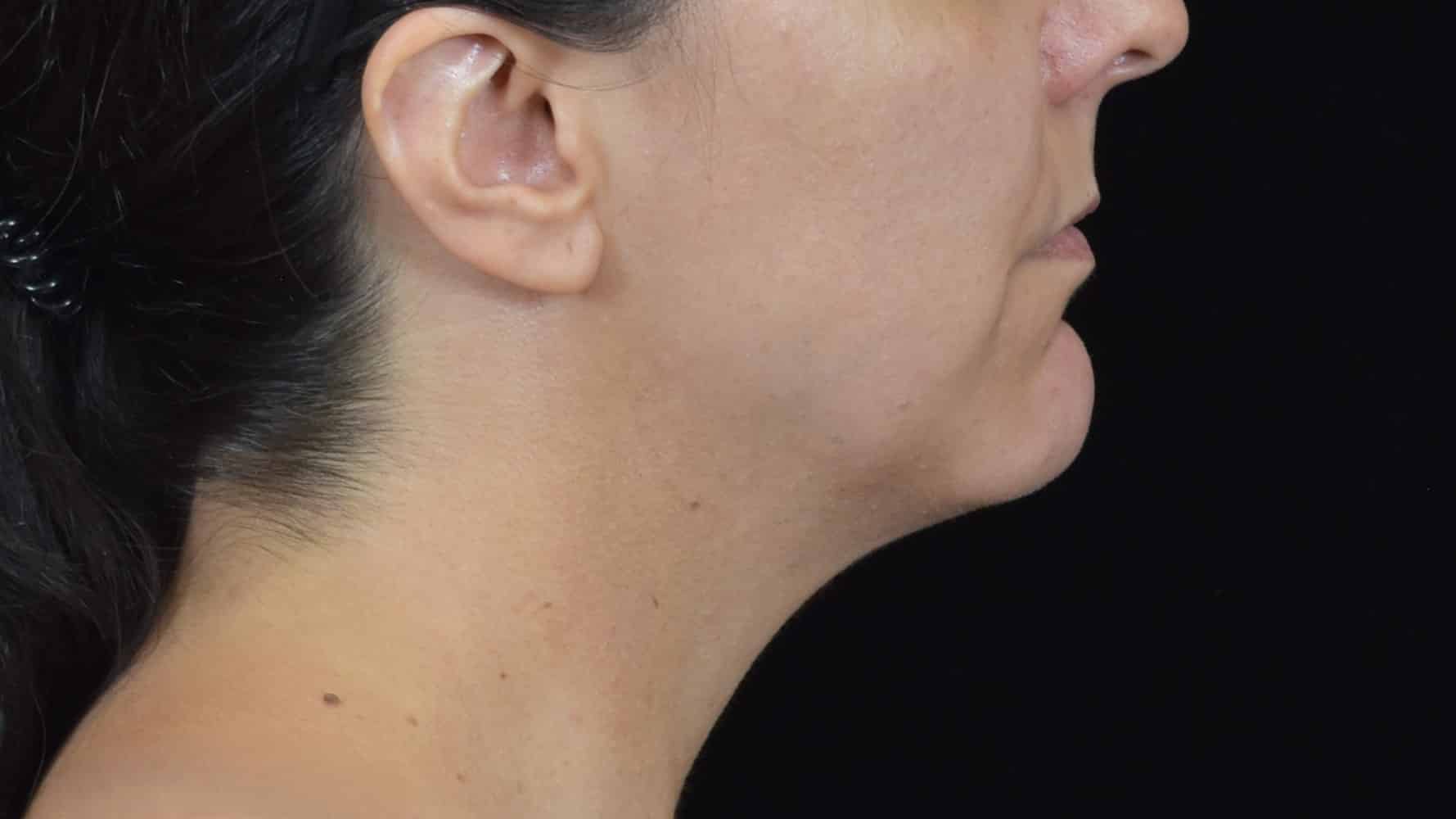 FaceTite/Accutite/Neck & Jawline Liposuction Patient Photo - Case 8634 - before view-1