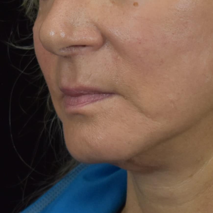 Dermal Fillers Patient Photo - Case 8681 - before view-