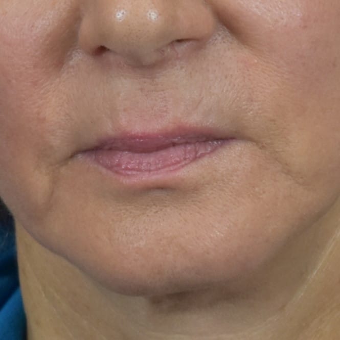 Dermal Fillers Patient Photo - Case 8681 - before view-1