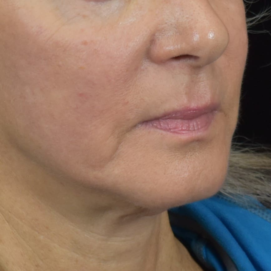 Dermal Fillers Patient Photo - Case 8681 - before view-2