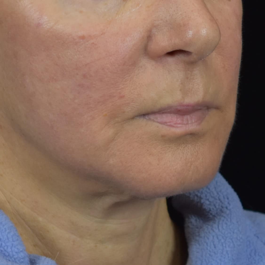 Dermal Fillers Patient Photo - Case 8681 - after view-2