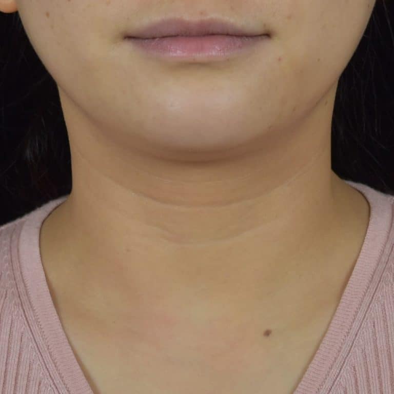 Dermal Fillers - Case 8689 - Before