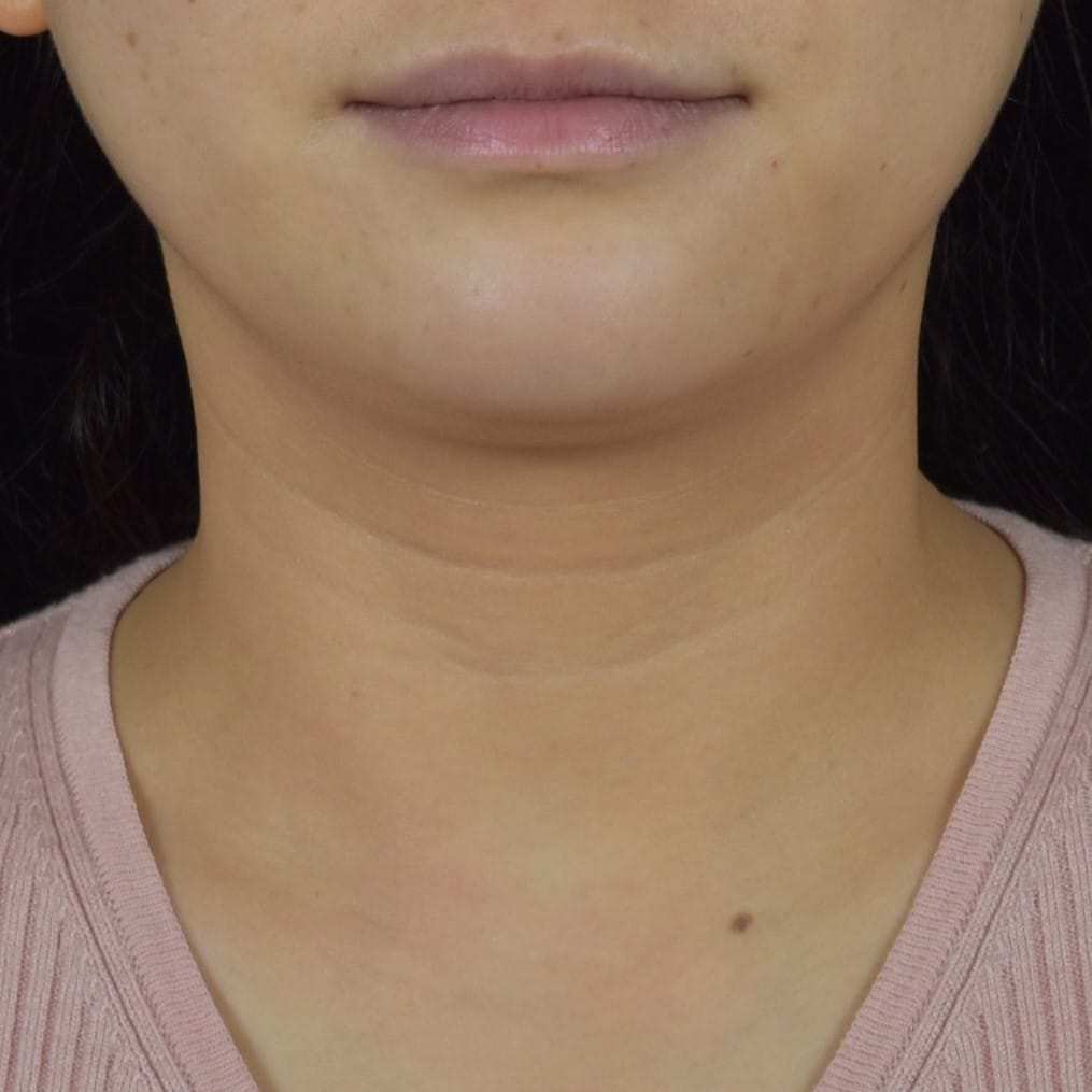 Dermal Fillers Patient Photo - Case 8689 - before view-