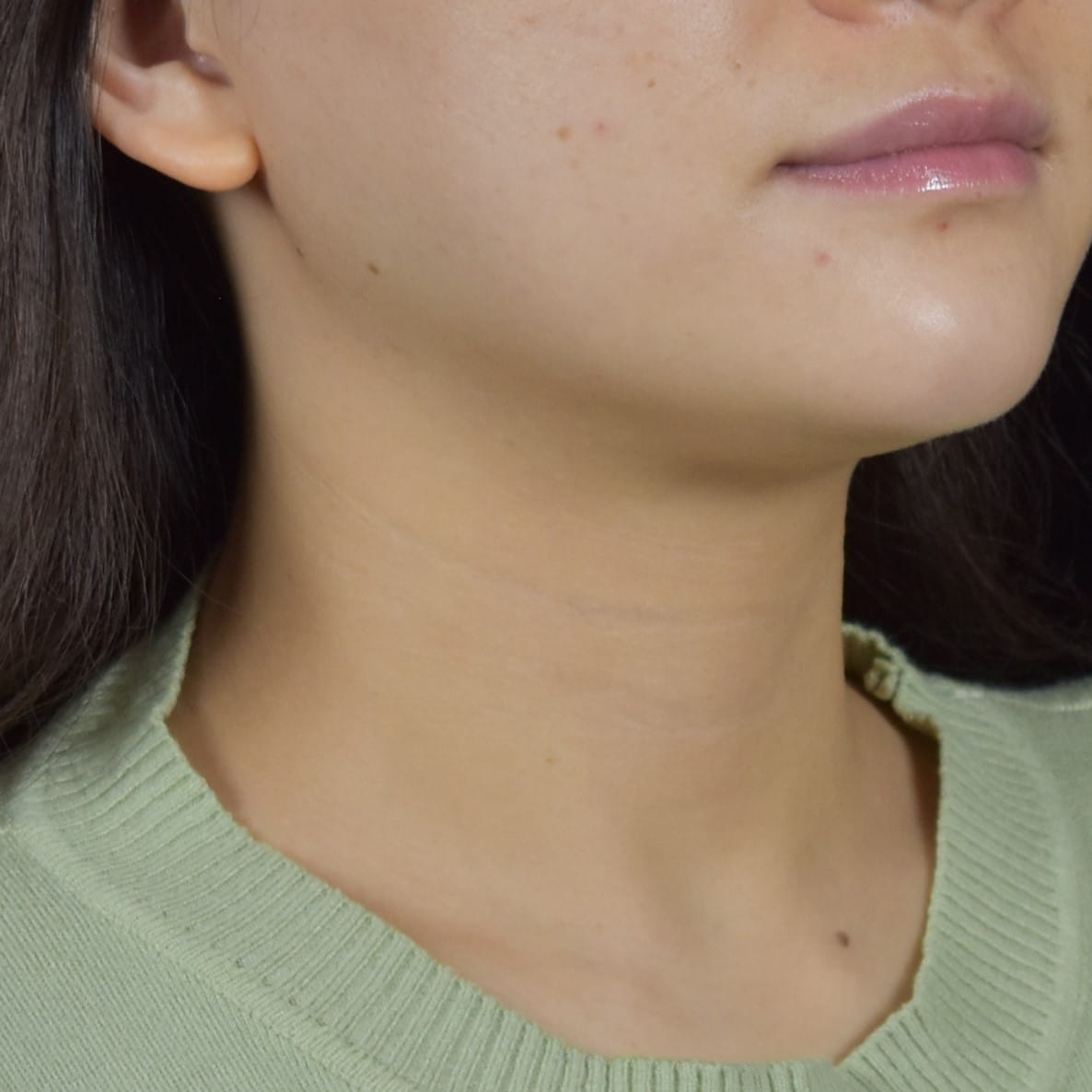 Dermal Fillers Patient Photo - Case 8689 - after view-1