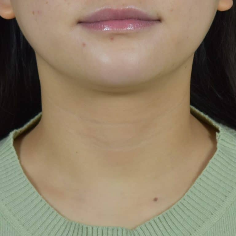 Dermal Fillers - Case 8689 - After