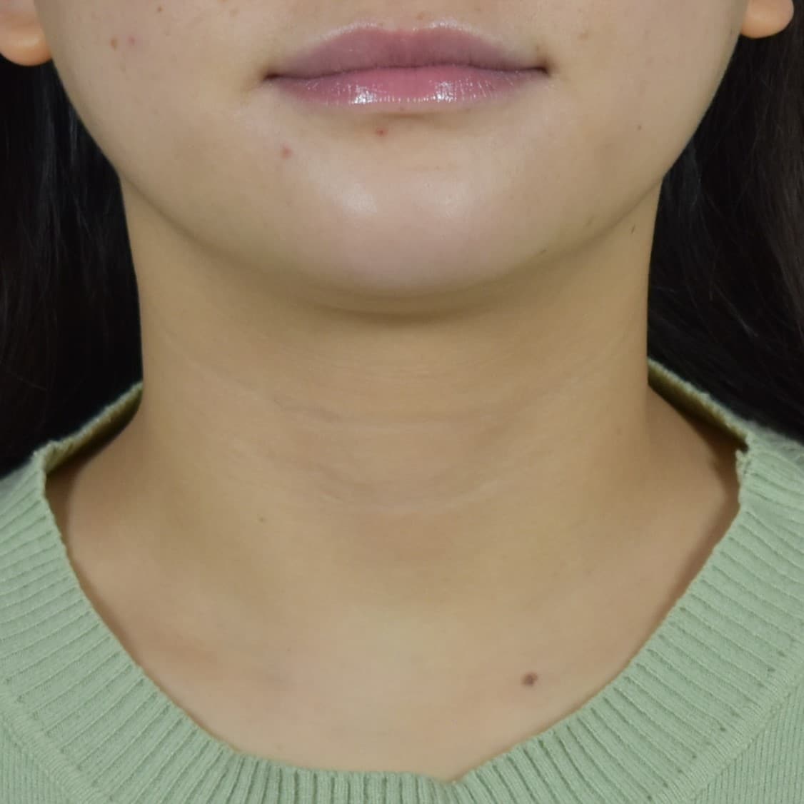 Dermal Fillers Patient Photo - Case 8689 - after view