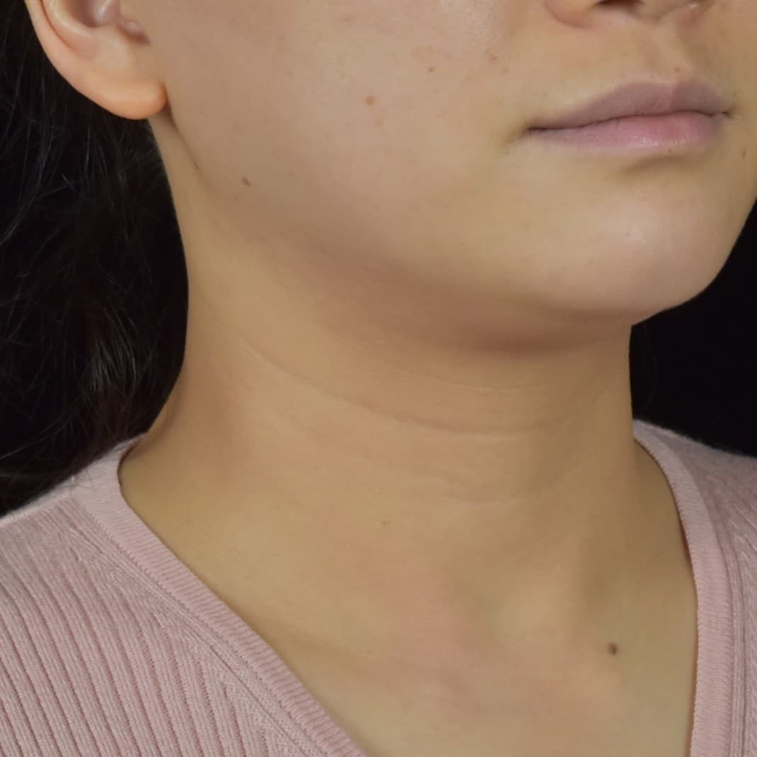 Dermal Fillers Patient Photo - Case 8689 - before view-1