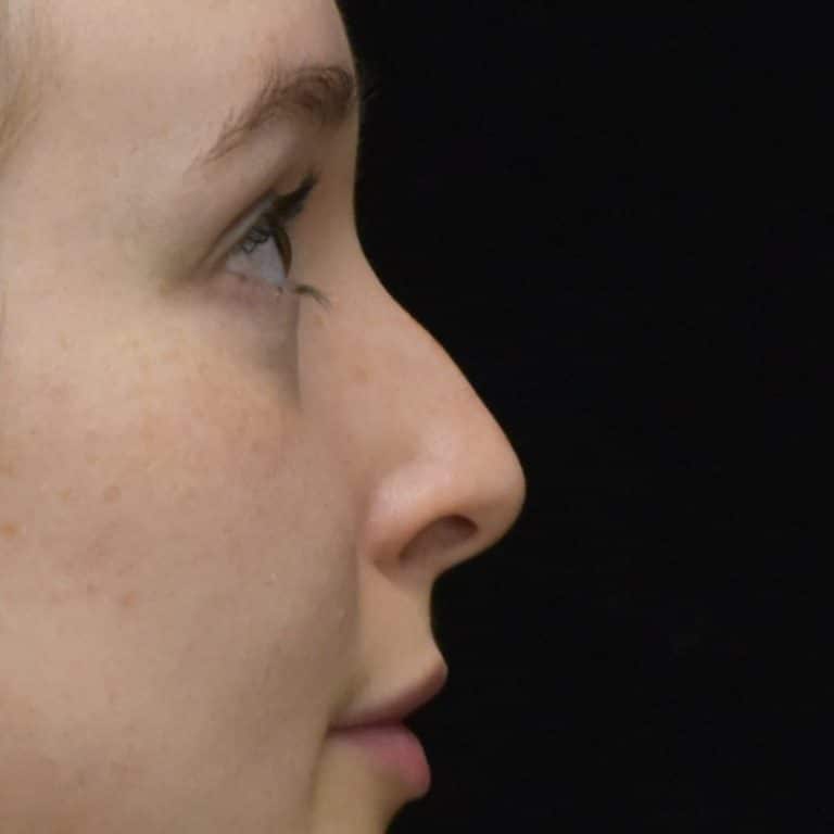 Dermal Fillers - Case 8695 - Before