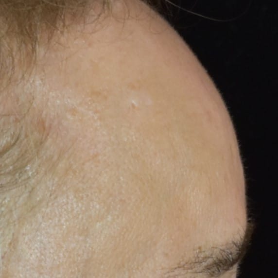 Lumecca IPL (Intense Pulsed Light) Patient Photo - Case 8699 - after view-1