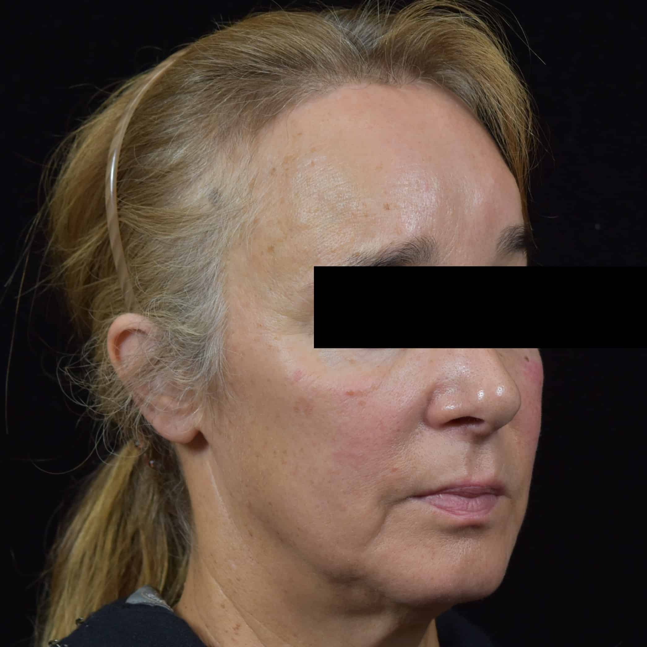 Lumecca IPL (Intense Pulsed Light) Patient Photo - Case 8699 - before view-2