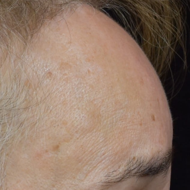 Lumecca IPL (Intense Pulsed Light) Patient Photo - Case 8699 - before view-1
