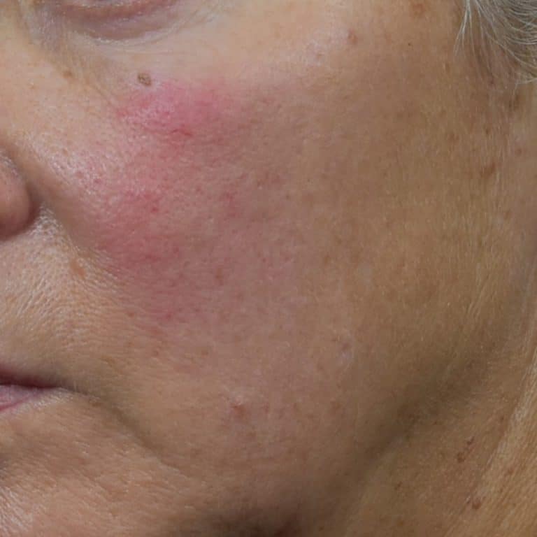 Lumecca IPL (Intense Pulsed Light) - Case 8699 - Before