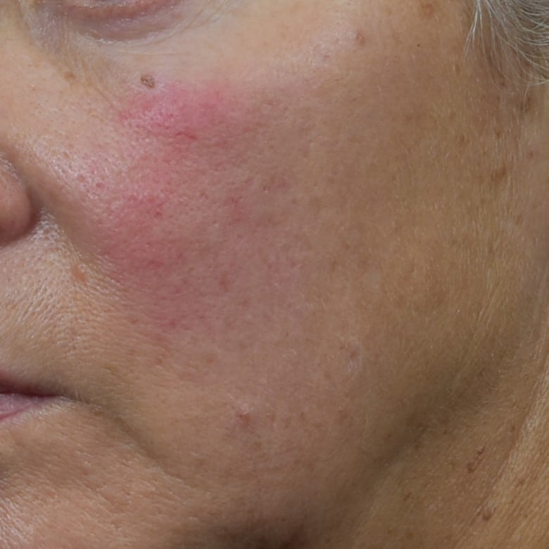 Lumecca IPL (Intense Pulsed Light) Patient Photo - Case 8699 - before view-