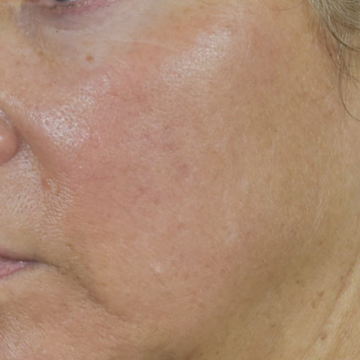 Lumecca IPL (Intense Pulsed Light) Patient Photo - Case 8699 - after view