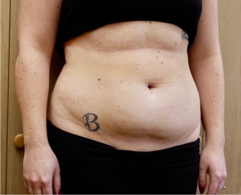 Quantum RF Contouring - Case 8707 - Before