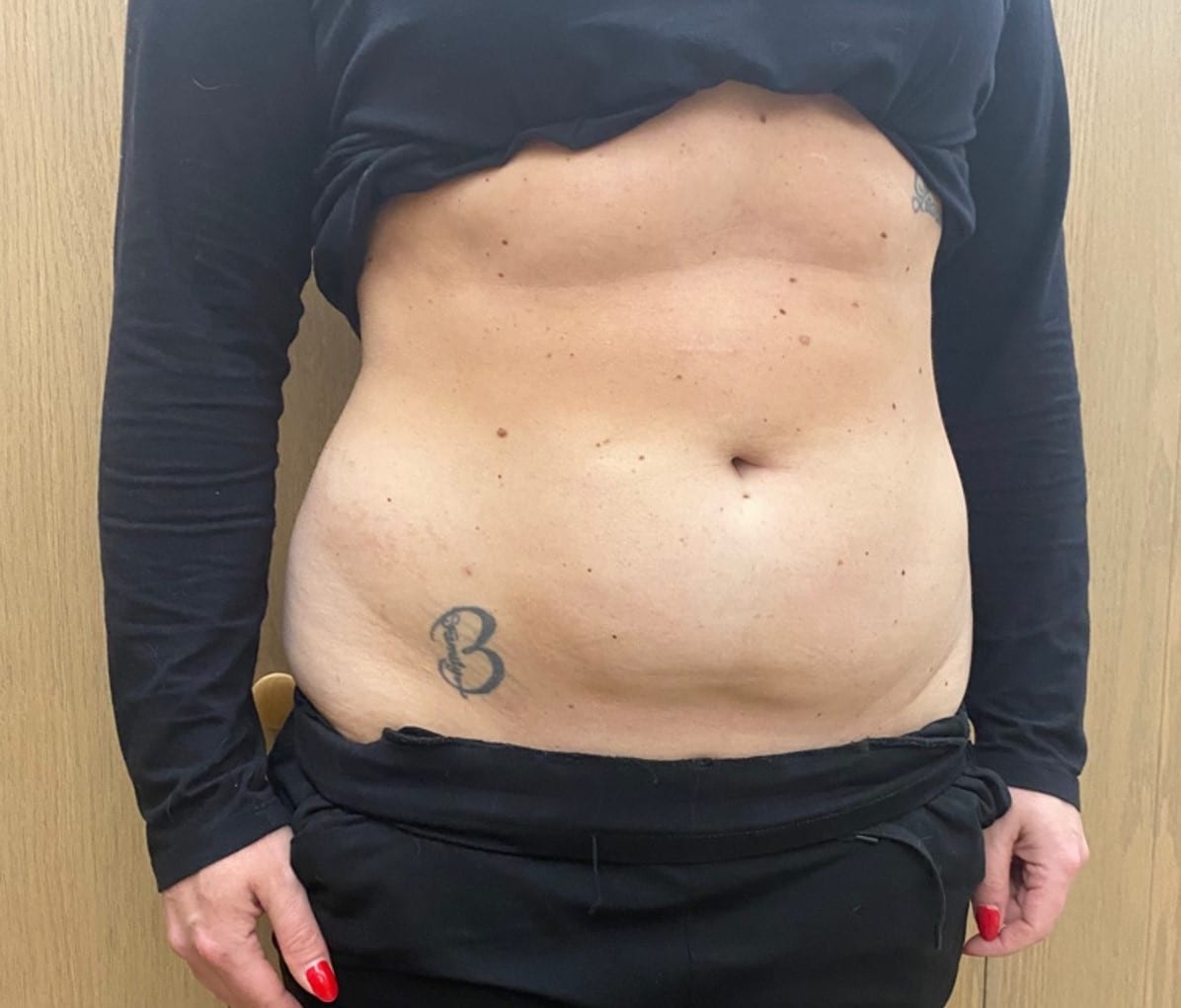 Quantum RF Contouring Patient Photo - Case 8707 - after view