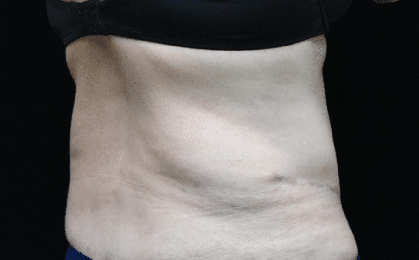 Quantum RF Contouring Patient Photo - Case 8711 - before view-