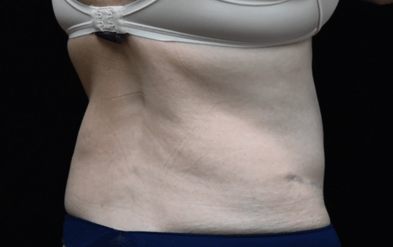 Quantum RF Contouring - Case 8711 - After