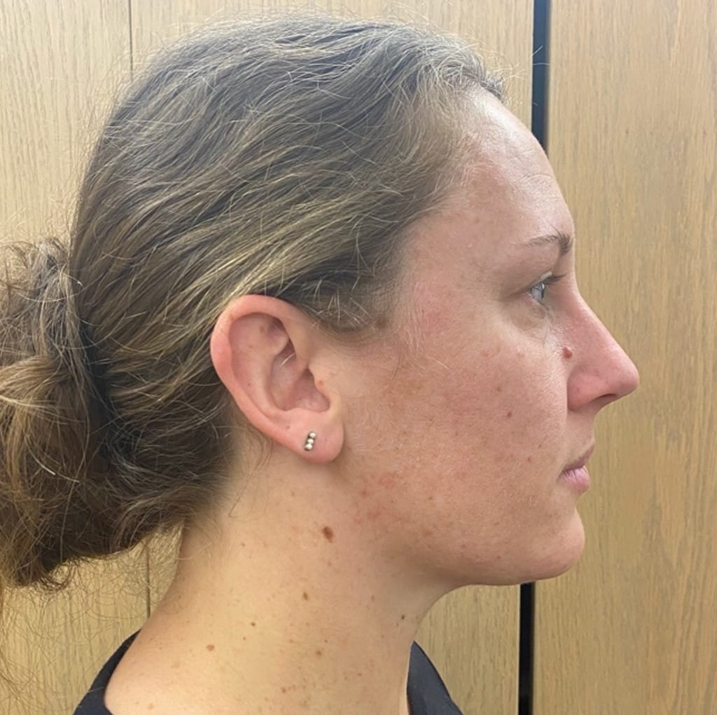 Quantum RF Contouring Patient Photo - Case 8715 - after view-1