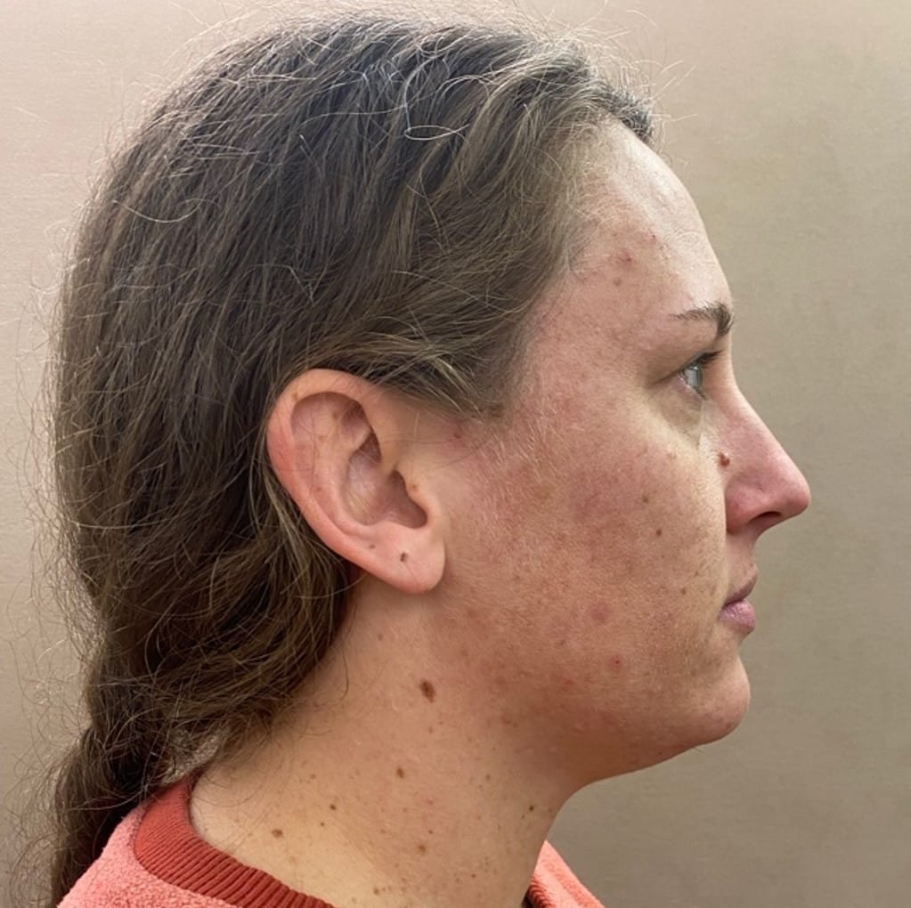 Quantum RF Contouring Patient Photo - Case 8715 - before view-1