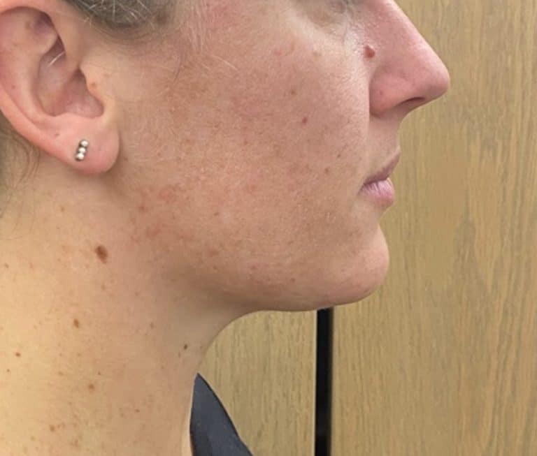 Quantum RF Contouring - Case 8715 - After